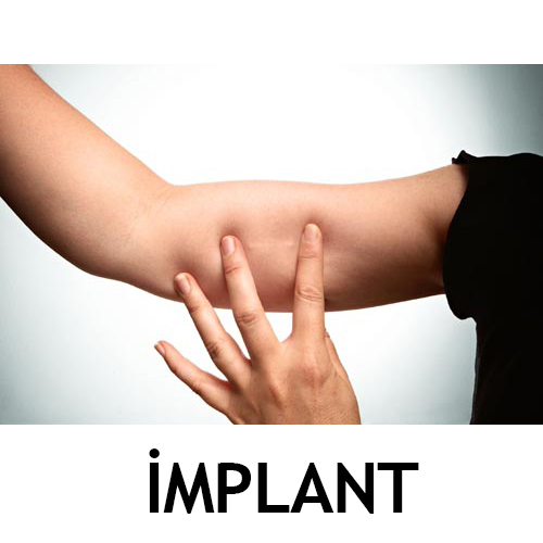 implant