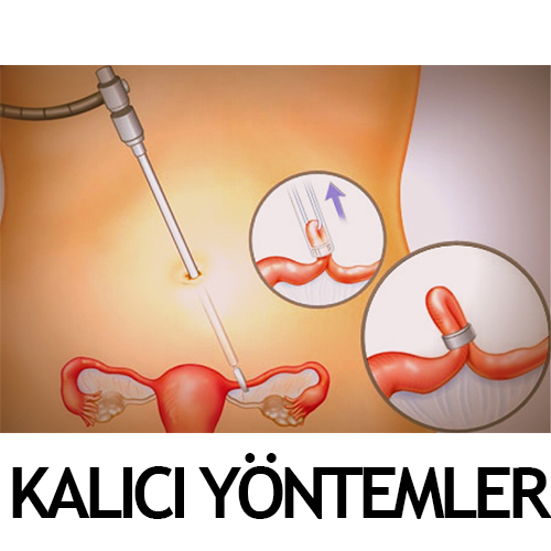 kalıcı yöntemler