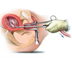 kürtaj tekniği